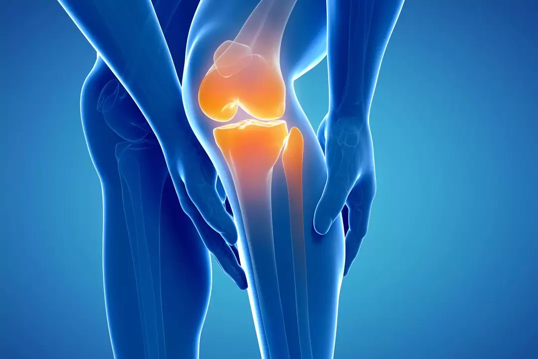 Osteoarthritis of the knee joint (gonarthrosis, osteoarthritis deformans)