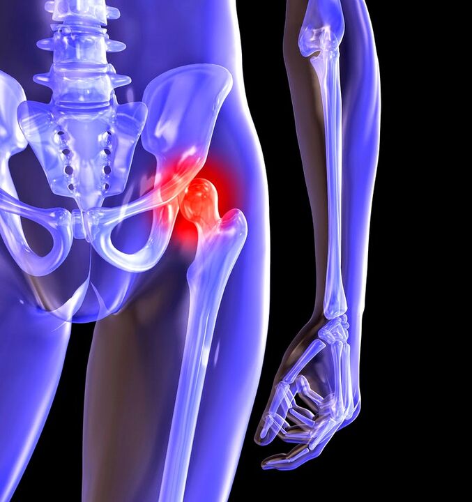 Deforming arthrosis of hip joint