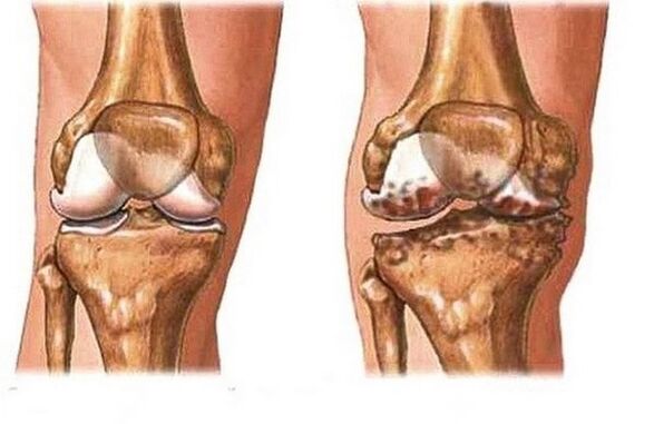 Healthy and painful articulation