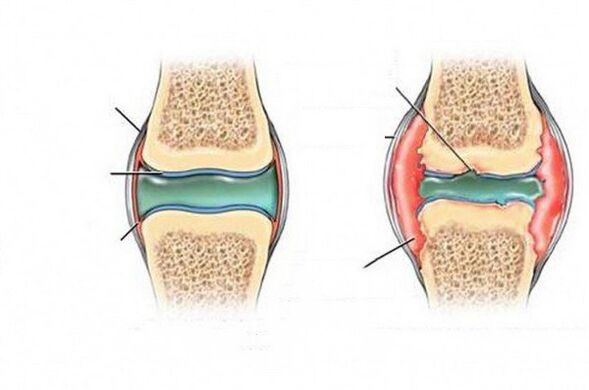 The joint deformation process