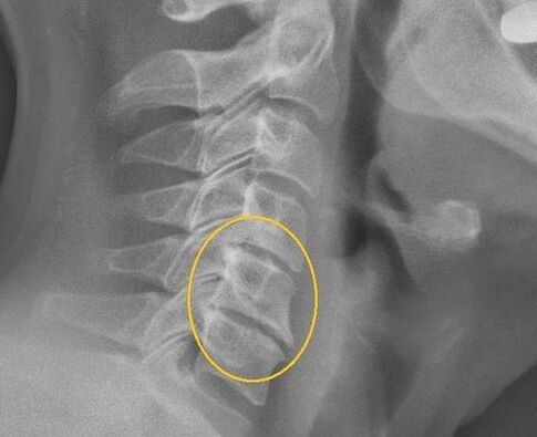 Cervical spine osteochondrosis in an x ​​-ray