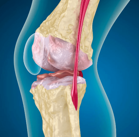 Knee articulation arthrrosis
