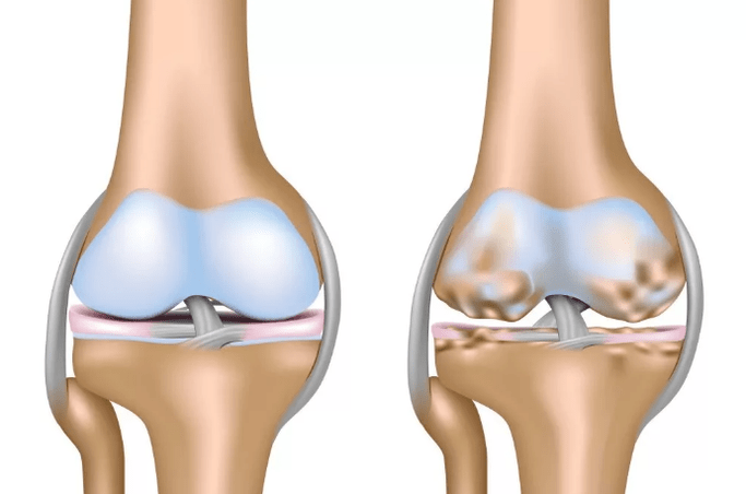 Knee articulation deforming arthrosis